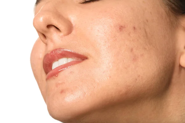 Young woman with acne problem on white background, closeup — Stock Photo, Image