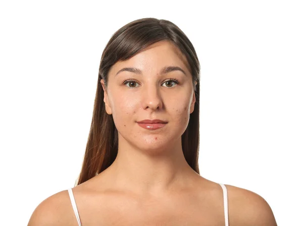 Mujer joven con problemas de acné sobre fondo blanco —  Fotos de Stock