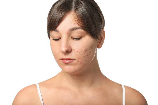 Young woman with acne problem on white background — Stock Photo, Image