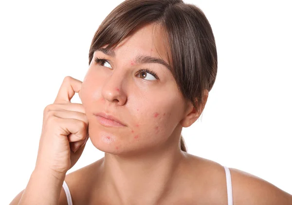 Young woman with acne problem on white background — Stock Photo, Image