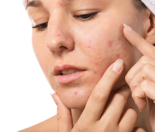 Young woman with acne problem on white background, closeup — Stock Photo, Image
