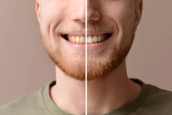 Člověk před a po bělení zubů na barevném pozadí — Stock fotografie