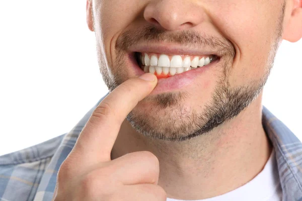 Man with gum inflammation on white background, closeup — Stok Foto