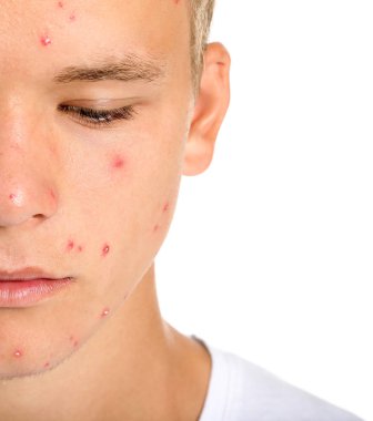 Beyaz arka planda akne sorunu olan genç çocuk