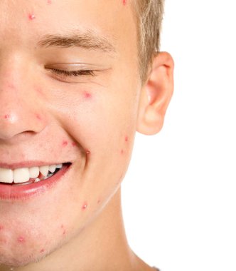 Beyaz arka planda akne sorunu olan genç çocuk