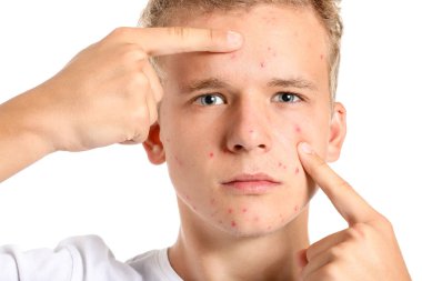 Beyaz arka planda akne sorunu olan genç çocuk