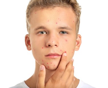Beyaz arka planda akne sorunu olan genç çocuk
