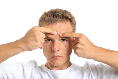 Sivilceleri beyaz arka planda ezen sivilceli genç bir çocuk.