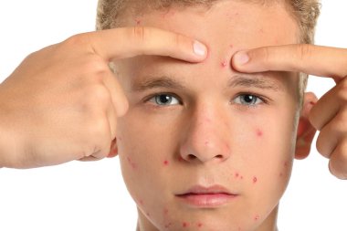 Sivilceleri beyaz arka planda ezen sivilceli genç bir çocuk.