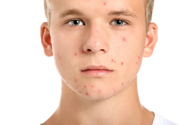 Teenage boy with acne problem on white background — Stock Photo, Image