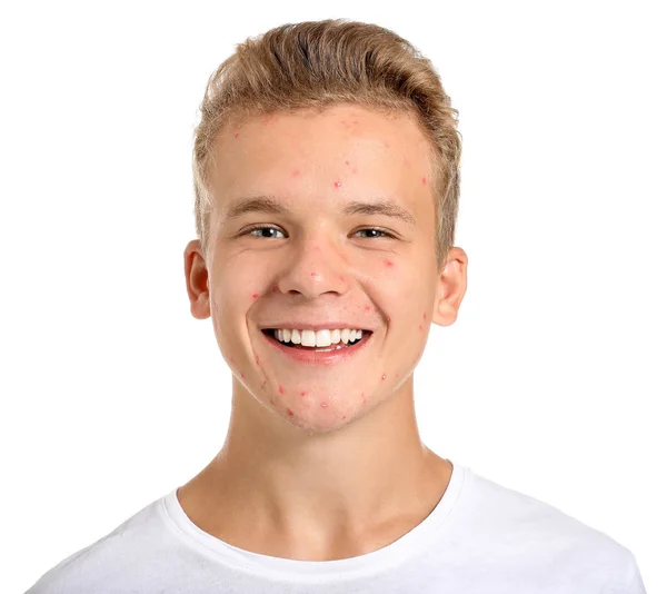 Nastoletni chłopiec z problemem trądziku na białym tle — Zdjęcie stockowe