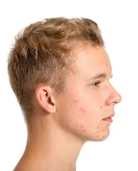 Adolescente chico con acné problema sobre fondo blanco — Foto de Stock
