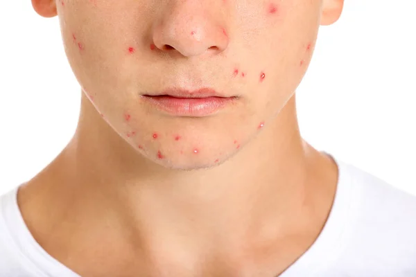 Teenage chlapec s akné problém na bílém pozadí, detailní záběr — Stock fotografie