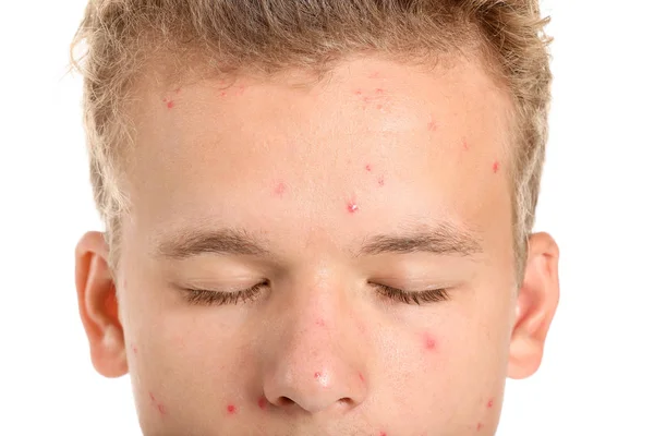 Teenage chlapec s akné problém na bílém pozadí, detailní záběr — Stock fotografie