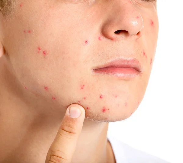 Teenage boy with acne problem on white background, closeup