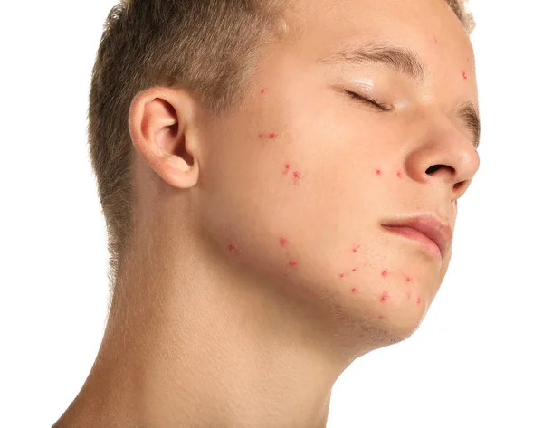 Teenage boy with acne problem on white background — Stock Photo, Image