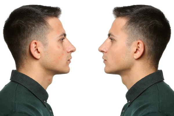 Young man with and without acne problem on white background — ストック写真