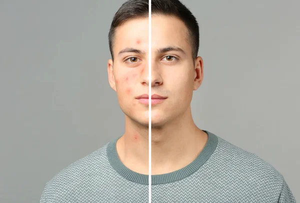 Joven con y sin acné problema sobre fondo gris — Foto de Stock