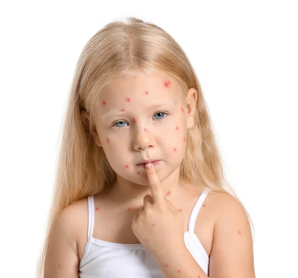 Little girl ill with chickenpox on white background — Stock Photo, Image