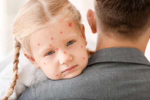 Muž, který se stará o svou dcerku s neštovicemi doma — Stock fotografie