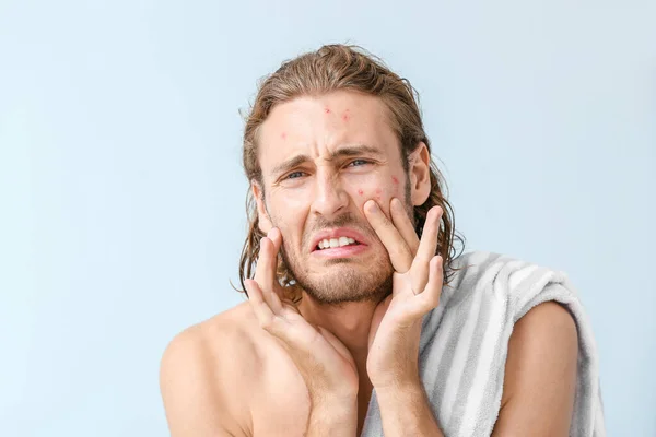 Porträt eines jungen Mannes mit Akne-Problem auf farbigem Hintergrund — Stockfoto