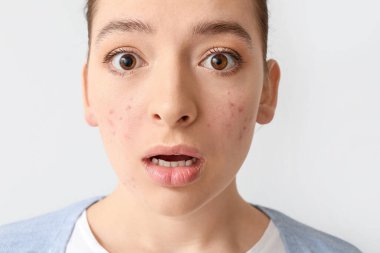 Açık arkaplanda sivilce sorunu olan genç bir kadın.