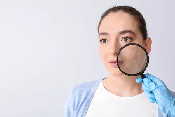 Young Woman Acne Problem Doctor Hand Magnifier Light Background — Stock Photo, Image