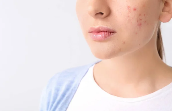 Young Woman Acne Problem Light Background — Stock Photo, Image