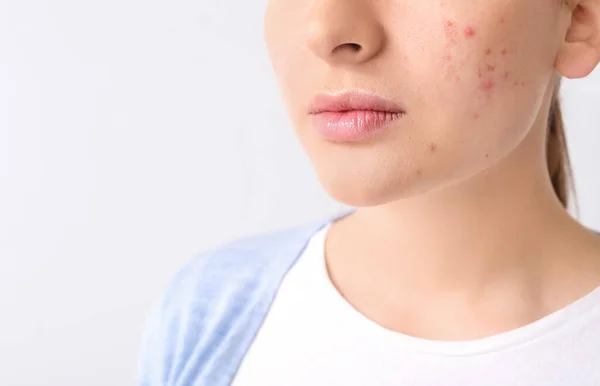 Jeune Femme Avec Problème Acné Sur Fond Clair — Photo