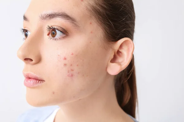 Mujer Joven Con Problemas Acné Fondo Claro — Foto de Stock