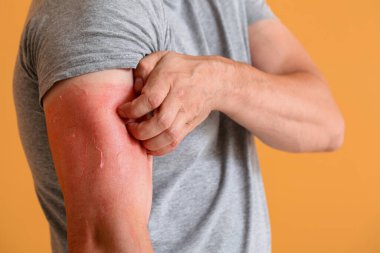 Renk arkaplanına karşı kırmızı güneş yanığı olan adam, yakın plan.