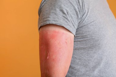 Man with red sunburned skin against color background, closeup clipart