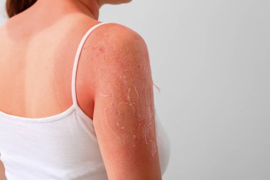 Woman with red sunburned skin against light background, closeup clipart
