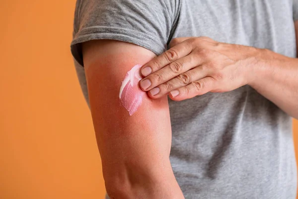 Hombre Con Piel Roja Quemada Por Sol Aplicando Crema Sobre —  Fotos de Stock