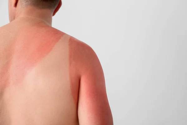 Άνθρωπος Κόκκινο Ηλιοκαμένο Δέρμα Φόντο Φως — Φωτογραφία Αρχείου