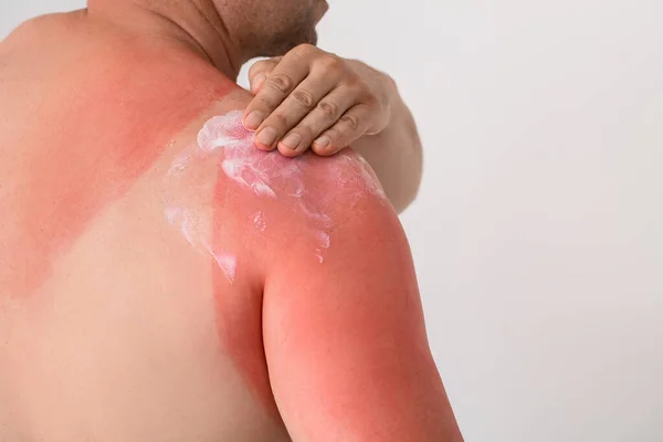 Άνδρας Κόκκινο Ηλιοκαμένο Δέρμα Εφαρμογή Κρέμα Ανοιχτό Φόντο Closeup — Φωτογραφία Αρχείου
