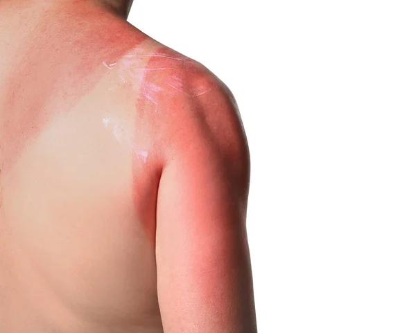 Άνδρας Κόκκινο Ηλιοκαμένο Δέρμα Και Προστατευτική Κρέμα Λευκό Φόντο — Φωτογραφία Αρχείου