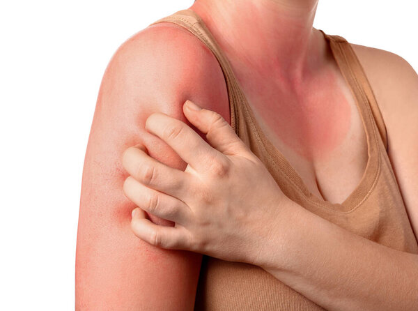Woman with red sunburned skin against white background, closeup