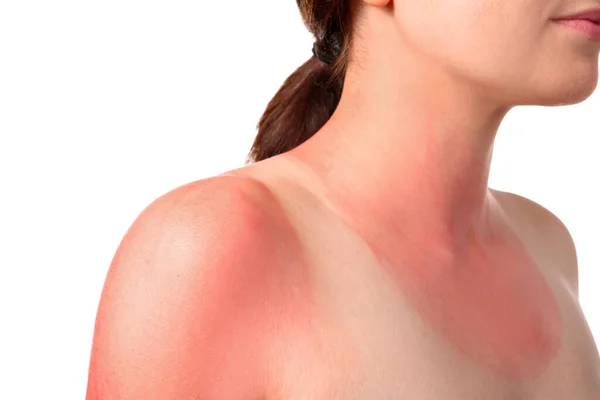 Γυναίκα Κόκκινο Ηλιοκαμένο Δέρμα Λευκό Φόντο Κοντινό Πλάνο — Φωτογραφία Αρχείου