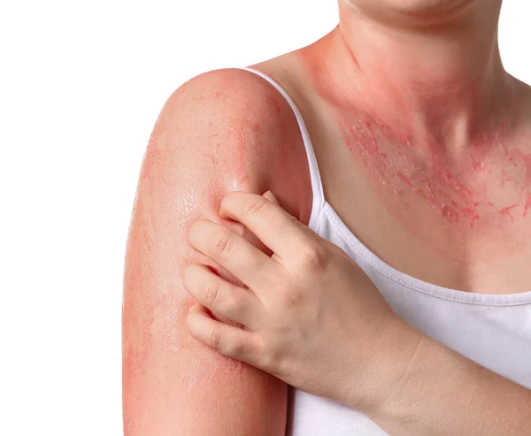 Mujer Con Piel Roja Quemada Por Sol Sobre Fondo Blanco —  Fotos de Stock