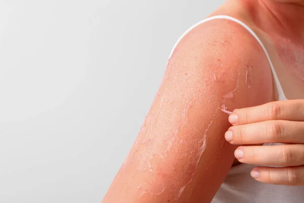 Woman with red sunburned skin against light background, closeup