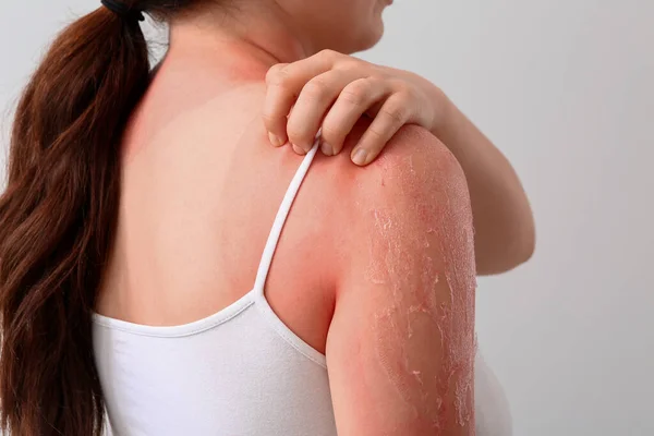Woman Red Sunburned Skin Light Background Closeup — Stock Photo, Image