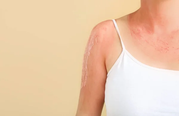 stock image Woman with red sunburned skin against color background, closeup