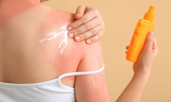 Γυναίκα Κόκκινο Ηλιοκαμένο Δέρμα Εφαρμογή Κρέμα Κατά Χρώμα Φόντο Closeup — Φωτογραφία Αρχείου