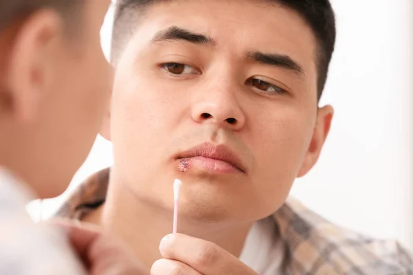 Asian man with cold sore applying ointment on his lips near mirror