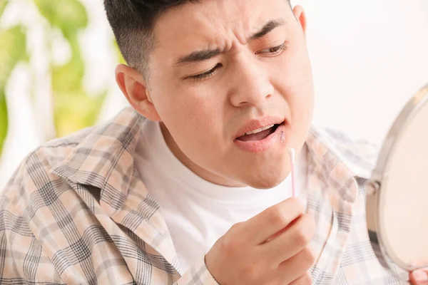 Asian Man Cold Sore Applying Ointment His Lips — Stock Photo, Image