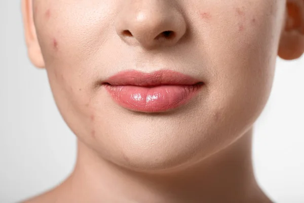Young Woman Acne Problem Light Background Closeup — Stock Photo, Image