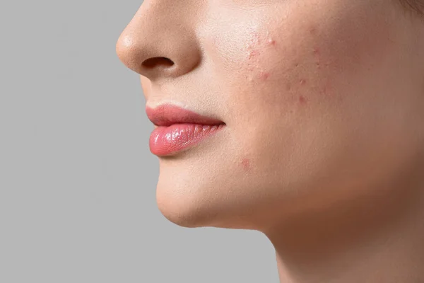 Young Woman Acne Problem Light Background Closeup — Stock Photo, Image