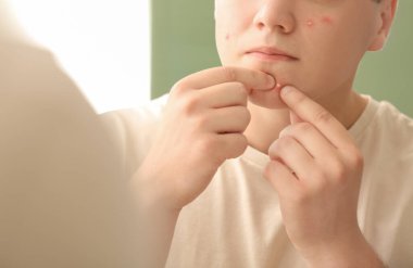 Sivilceli genç çocuk aynanın yanında sivilceleri eziyor.