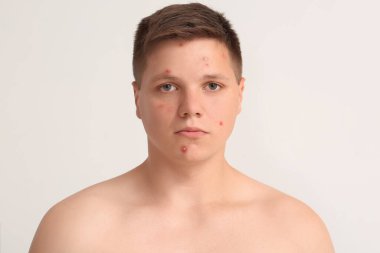 Sivilceli genç bir çocuk.